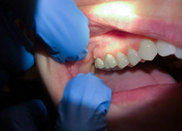 Best Emergency Tooth Extraction in Morningside, MD